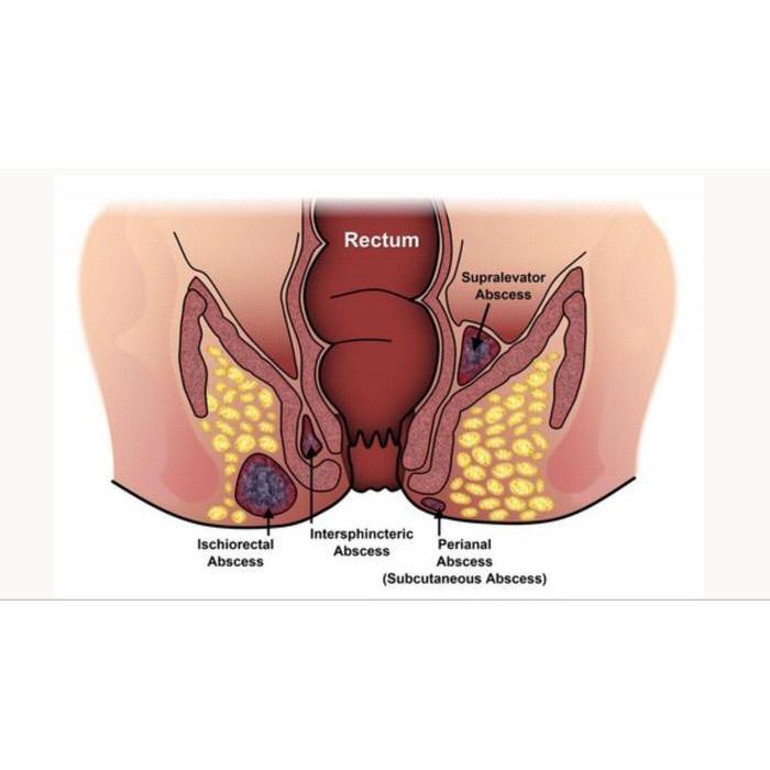 arka- Wasiri Obat Ambeien Obat Wasir Isi 100 Pil Rekomendasi Sinshe