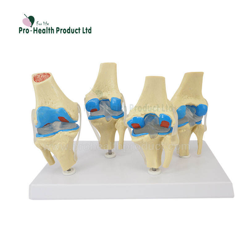 Joint Disease Knee Lesions Arthritis Knee Osteoarthritis Model Four Stage Degenerative