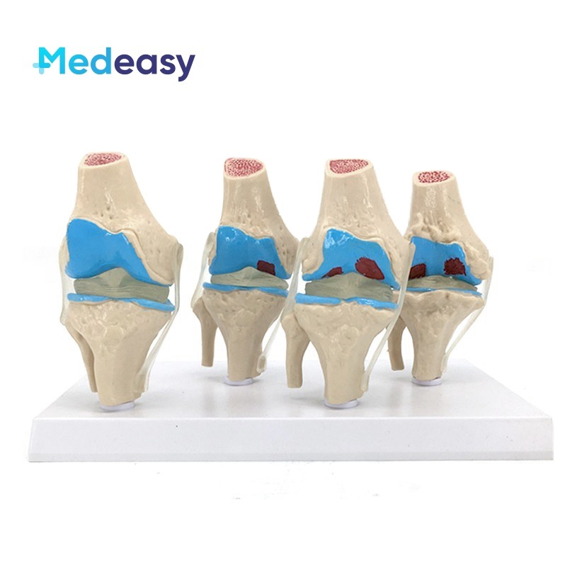 Human 4 Stage Osteoarthritis Knee Joint Model, Pathological Knee Model