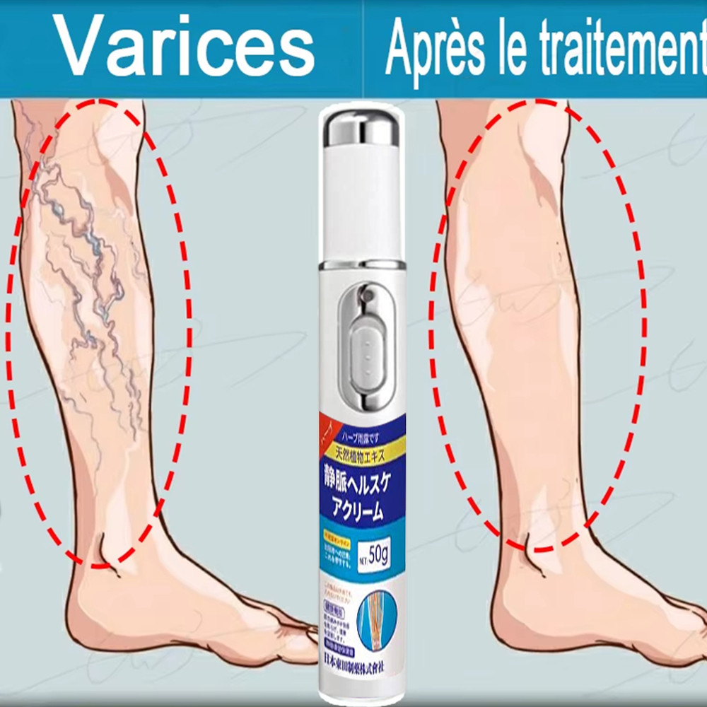 Laser pen for varicose veins, enlarged veins, spider legs, pain, unsightly veins, new laser pen for