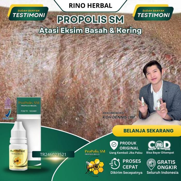 Eksim Kering Menahun, Eksim Basah Dan Kering Menahun, Eksim Kering, Eksim Basah, Eksim Gatal, Gatal