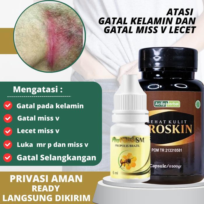 r5gf- Salep Gatal Mss V Lecet Kemaluan Pria Dan Wanita Atasi Jamur Kelamin Gatal Kelamin