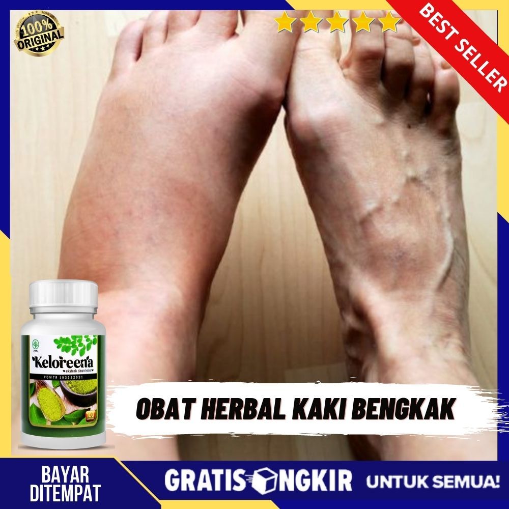 Obat Kaki Bengkak - Obat Untuk Sakit Tumit Kaki Bengkak, Radang Sendi Kaki, Keram Dan Kaku Pada Kaki