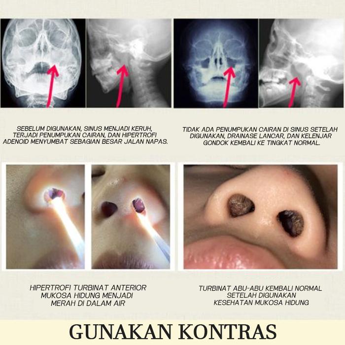 kv3g- Obat Sinusitis Semprot Hidung Obat Polip Hidung Semprotan Hidung Nasal Spray Sinusitis