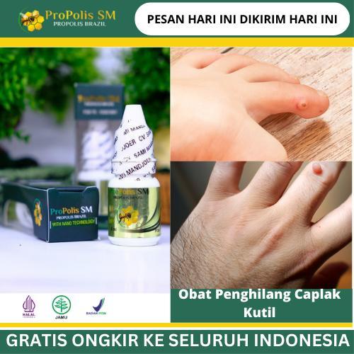 Herbal Propolis Caplak Kutil, Penghilang Kutil Daging Tumbuh, Kutil Papiloma, Bintik Bintik Di Jari,