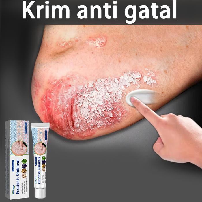gss krim gatal kulit Penyakit Kulit Gatal Seluruh Badan