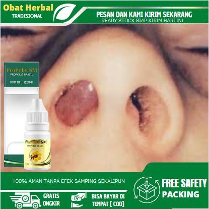 GIRLDAY- Tetes Polip Hidung, Benjolan Di Hidung, Sinusitis Menahun, Hidung Bau Busuk, Anosmia,