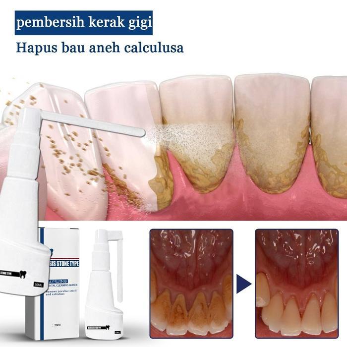 DAYDAY- Gigi Penghilang Karang 30Ml Pembersih Karang Gigi Membandel Alat Pembersih Karang Gigi