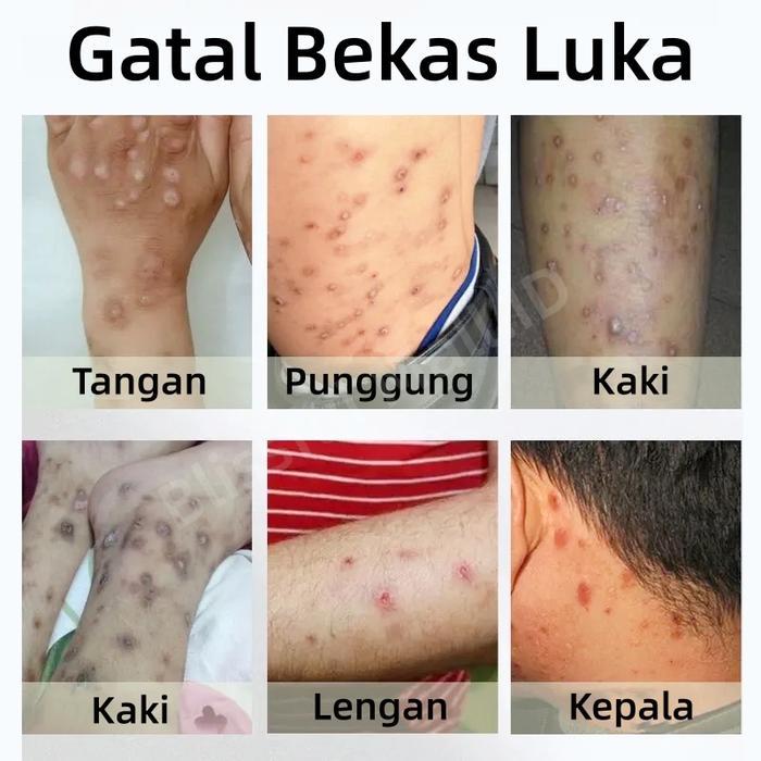 Penghilang bekas luka hitam koreng Penghilang bekas luka di kaki Penghilang Bekas luka bakar Bekas