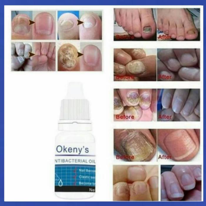 SERUM VITAMIN KUKU MENGOBATI JAMUR KUKU & KUKU RUSAK & CANTENGAN