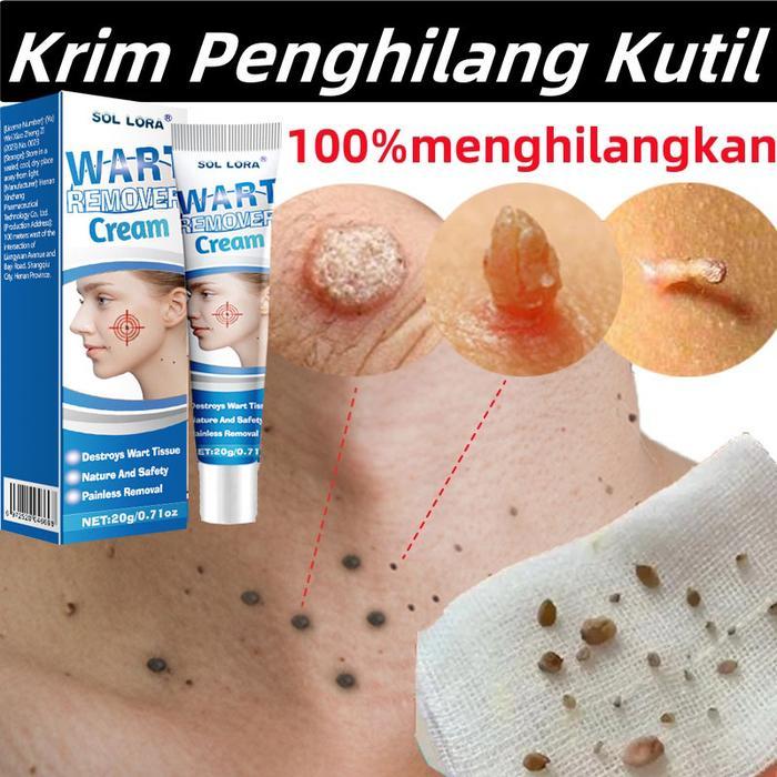 penghilang tahi lalat permanen Penghilang Kutil dan Tahi Lalat Salep Obat Kutil Paling Obat