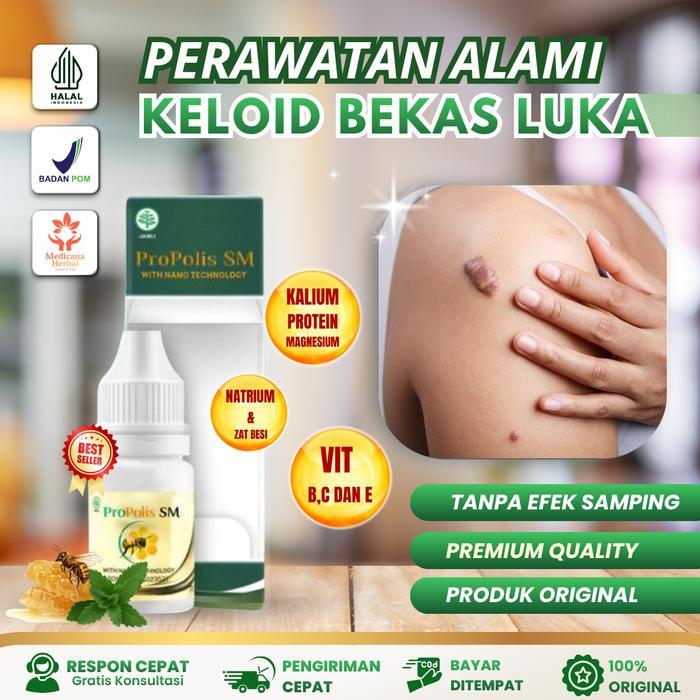 Propolis SM Untuk Keloid, Penghilang Keloid Bekas Luka, Skin Tag, Keloid Bekas Luka Tindik Operasi