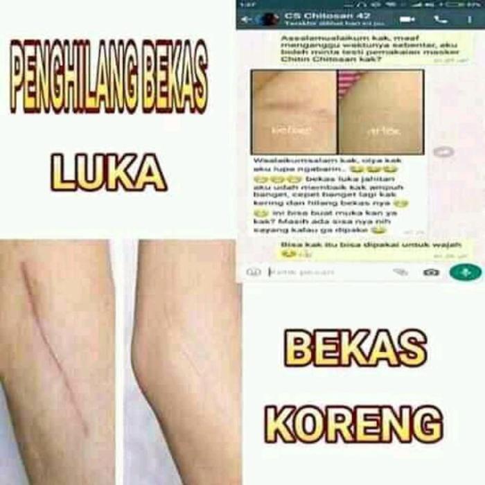 [TERPERCAYA] VHITA OIL VHITASOF TOIL AMPUH HILANGKAN BEKAS LUKA