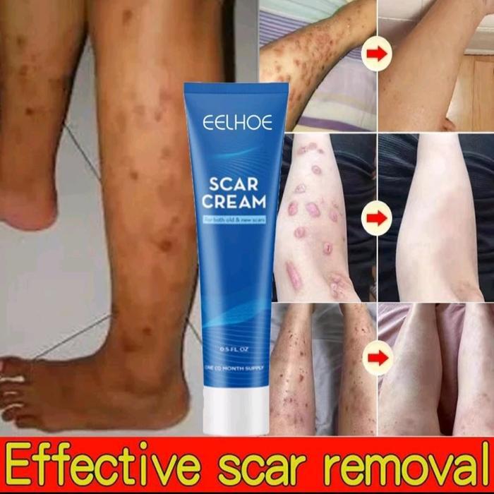 Salep Penghilang Bekas Luka Penghilang bekas Luka Hitam Scar Cream
