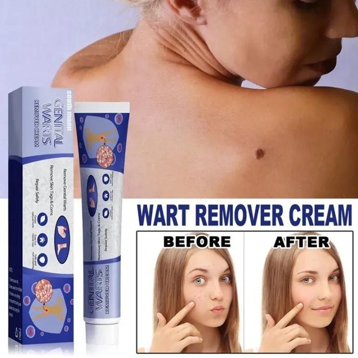 Wart Removal cream, Obat Penghilang Kutil Tahi-Lalat Paling Ampuh - Tanpa Perlu Operasi