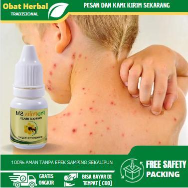 Cairan Oles Untuk Mengatasi Cacar, alep Cacar Ular, Cacar Air, Cacar Api, Cacar Monyet, Luka Bekas