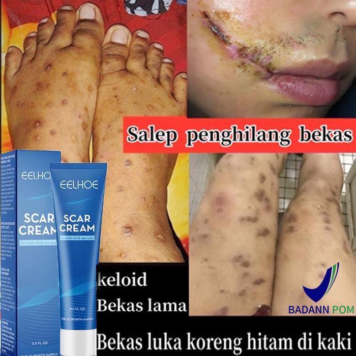COD-Promo khusus scar cream penghilang luka berbekas salep keloid paling ampuh bekas luka bekasluka