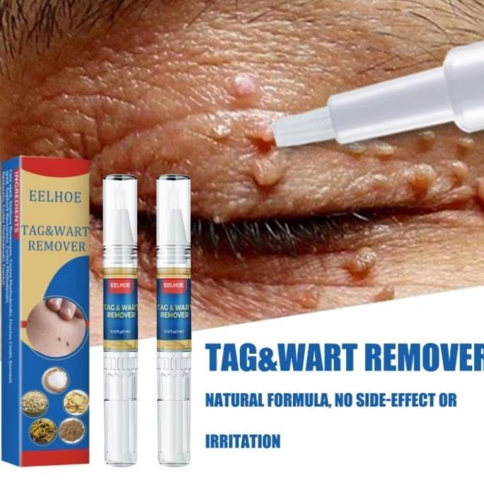 EELHOE Penghilang kutil &wart removal 20 gr