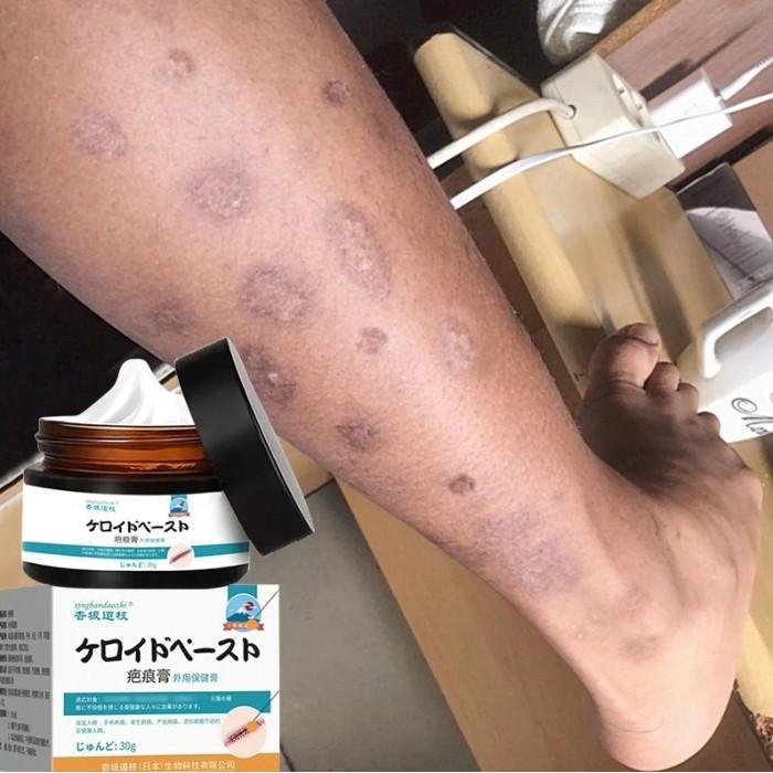CREAM PENGHILANG BEKAS LUKA LAMA MENGHITAM KORENG KULIT KAKI TANGAN SALEP KRIM OBAT PENGHILANG BEKAS