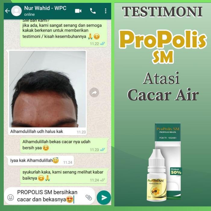 Propolis Sm - Cacar Air Bintik-Bintik Merah Berair Cacar Cacar Monyet Penghilang Bekas Cacar Di
