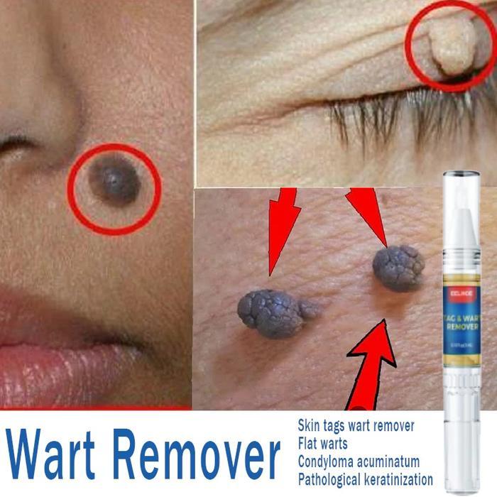 Penghilang Tahi Lalat Penghilang kutil ampuh Wart Remover Pen Skin tag remover Penghilang kutil di