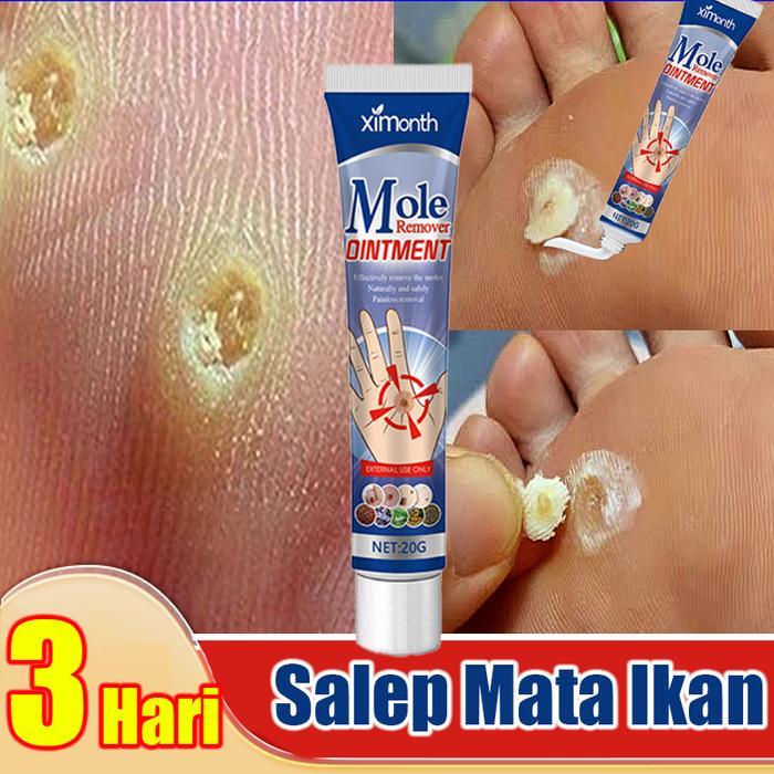 Salep Mata Ikan Ampuh Obat Mata Ikan Kaki Penghilang Mata Ikan Obat Penghilang Kutil Dan Tahi Lalat