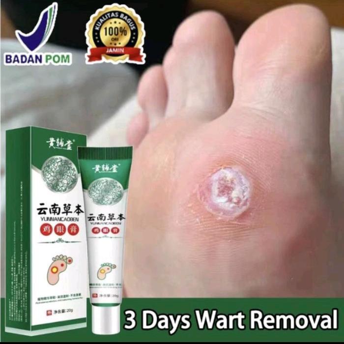 #Medicine#Obat Kutil kapalan mata ikan penghilang kutil mata ikan dan kapalan