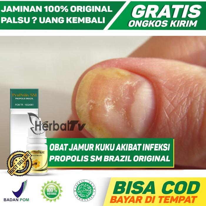 OBAT JAMUR KUKU - OBAT INFEKSI - HERBAL PSORIASIS - PITTING KUKU COD