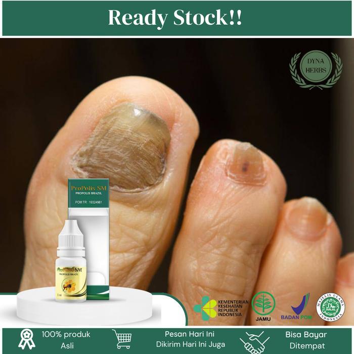 Tetes Psoriasis Kuku Berjamur, Infeksi Kuku Rusak Parah Akibat Jamur, Pitting Kuku Berlubang