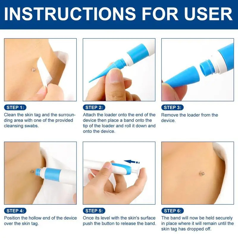 Skin Tag Removal Mole Wart Removal Facial Mole Wart Microstrip Tag Removal Kit Automatic Mole