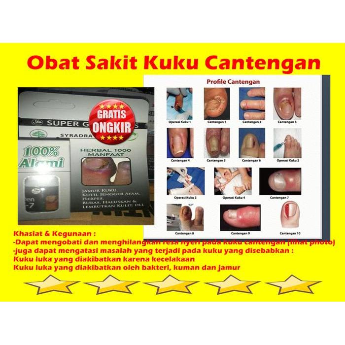 KUKU - SAKIT KUKU - CANTENGAN - OBAT SAKIT KUKU CANTENGAN