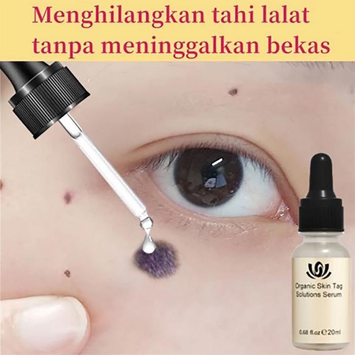 Penghilang Tahi Lalat Penghilang Kutil Penghilang Tahi Lalat Di Wajah Obat Penghilang Tahi Lalat