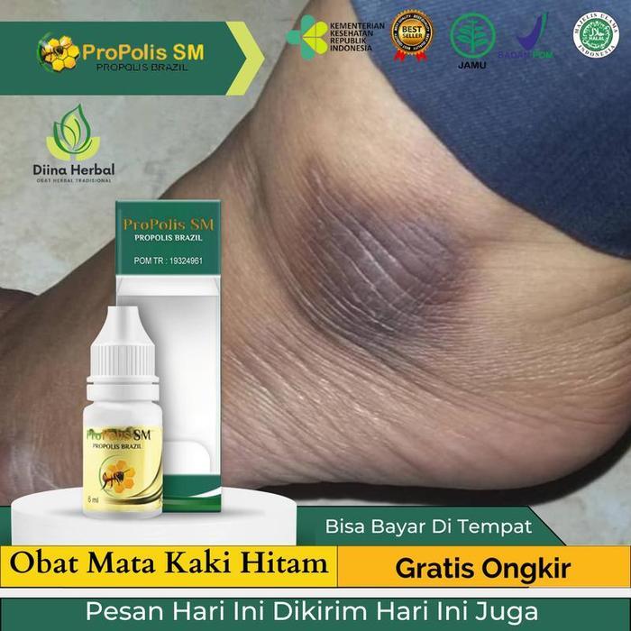 DISKON Pemutih Mata Kaki Hitam, Oles Mata Kaki Hitam, Mata Kaki Hitam Dan Kasar, Nyeri Mata Kaki