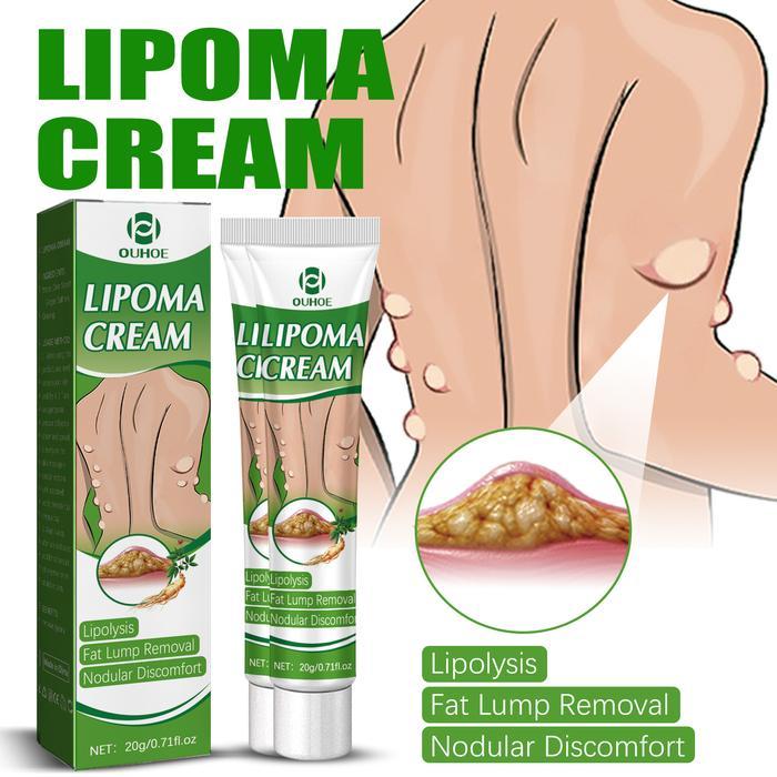 Lipoma cream original removal Fat granule care special removal of subcutaneous lipoma Mengurangkan