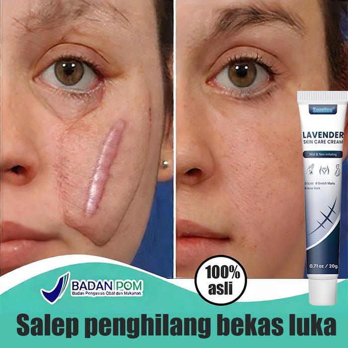 Salep penghilang bekas luka Herbal Salep Penghilang bekas luka Gel Penghilang bekas luka hitam
