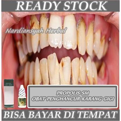 Sale Obat Penghancur Karang Gigi, Karang Gigi Gusi, Pembersih Karang Gigi