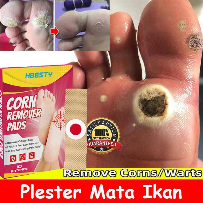Plester Mata Ikan Paling Ampuh Obat Mata Ikan Penghilang Mata Ikan Plester Kutil Dan Mata Ikan Foot