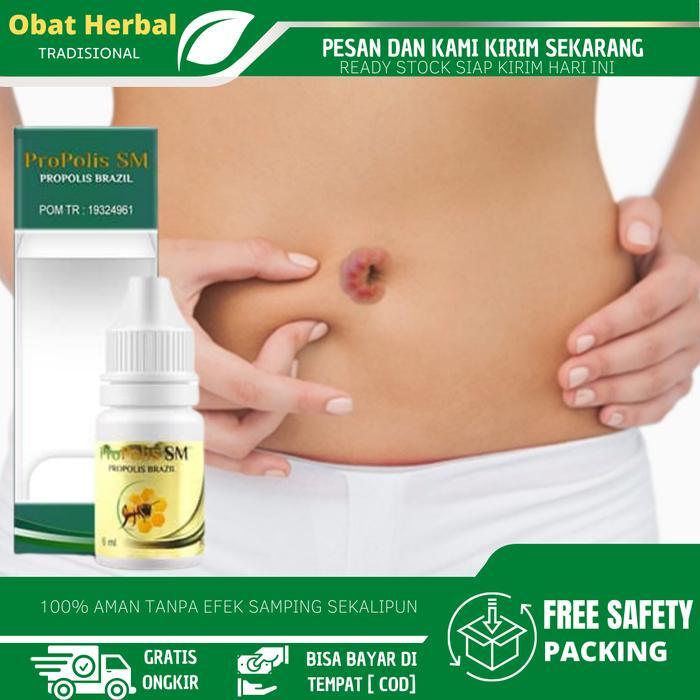 Propolis Sm Cairan Tetes Pusar Bernanah Bau Busuk, Gatal Pusar, Pusar Berair, Pusar Bengkak Untuk