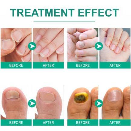 PENGHILANG JAMUR DI KUKU, KUKU RUSAK