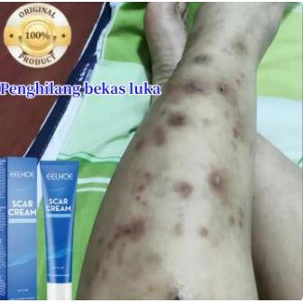 Penghilang bekas koreng hitam Penghilang bekas koreng lama Penghilang Bekas gigitan nyamu Keloid