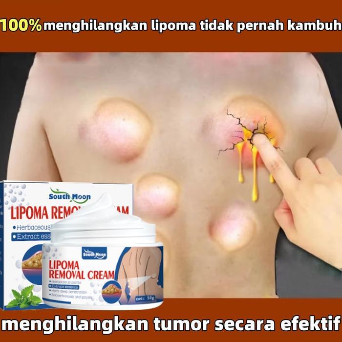 Lipoma Cream 100% Original salep lipoma salep benjolan Obat Benjolan Lipoma Krim obat benjolan