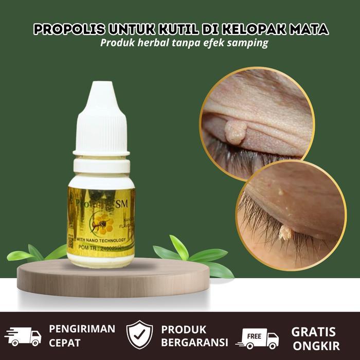 Propolis untuk kutil di kelopak mata, kutil diwajah, kutilan, skin tang, papiloma, daging jadi