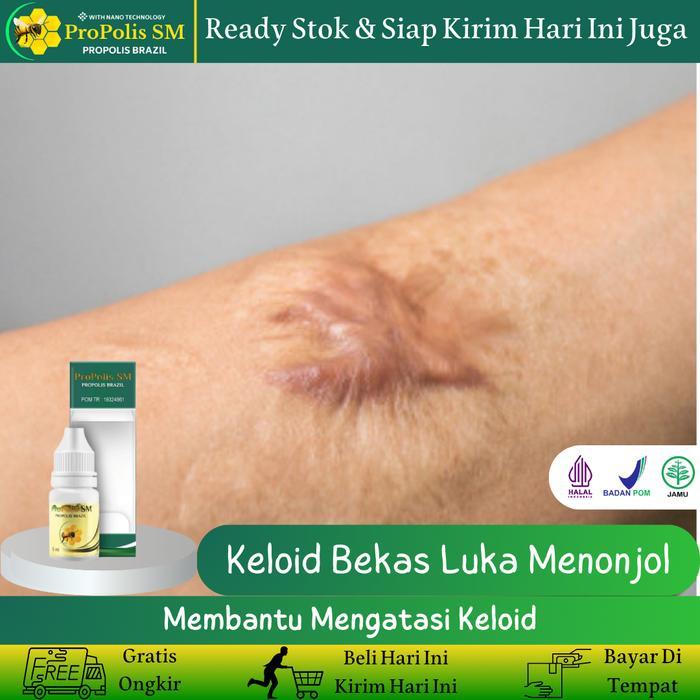 Propolis SM - Salep untuk menghilangkan keloid, menghilangkan keloid menonjol, menghilangkan