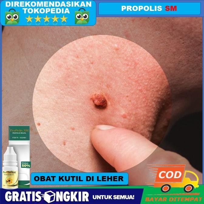 Obat Kutil di Leher, Obat Kutil di Wajah, Obat Kutil di Kelopak Mata