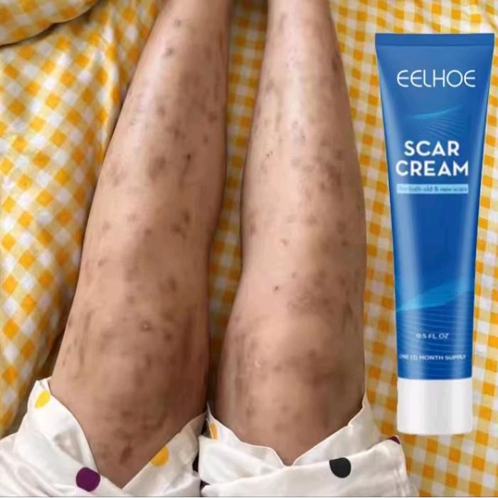 SCAR CREAM salep penghilang bekas luka bakar dan bekas luka koreng