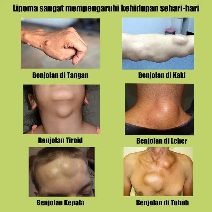 Krim pelembap tubuh Cream lipoma herbal Obat benjolan lipoma cream original lipoma cream obat lipoma