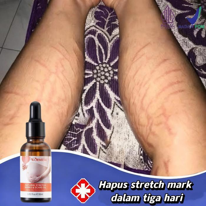Stretch mark cream stretch mark paling ampuh 30ml rintik stretch mark cream Krim Perawatan