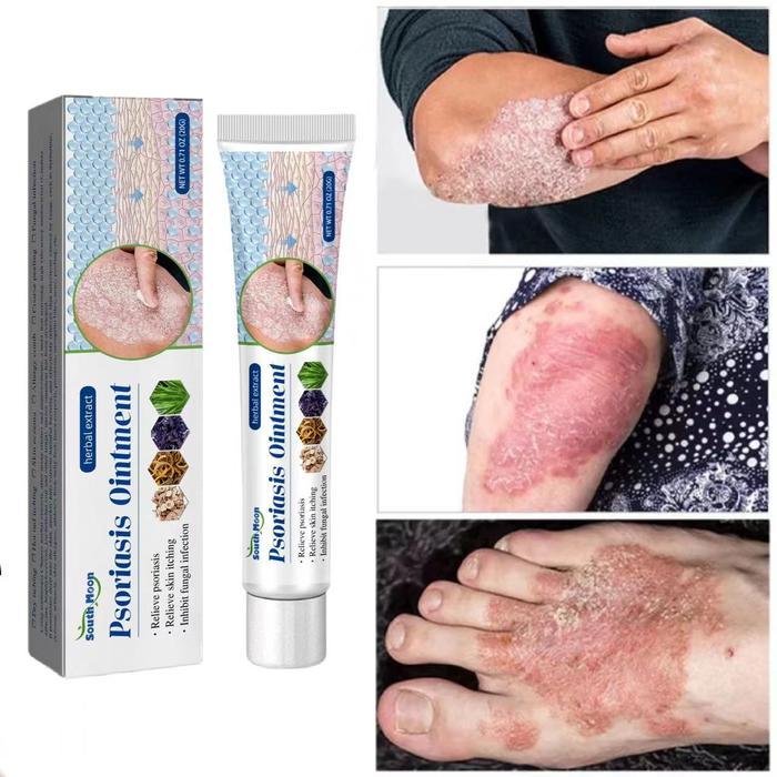 Salep khusus psoriasis ointment - import - kurap pada kulit kepala - kutu air - kurap pada badan -