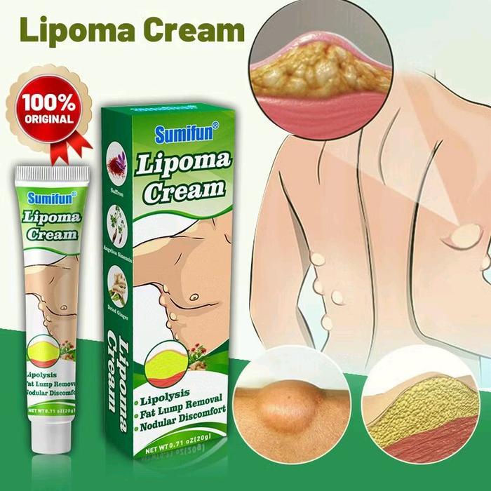 Krim Lipoma Benjolan Sumifun Lipoma Cream - solusi ampuh mengatasi benjolan pada tubuh Pembesar