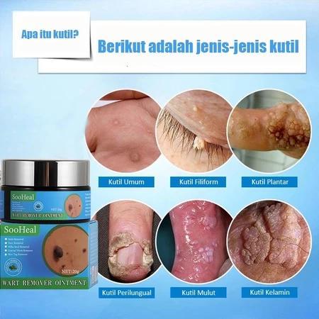 Penghilang kutil Salep kutil paling ampuh Salep kutil Obat penghilang kutil Salep kutil kelamin